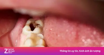 Đừng bỏ qua dấu hiệu sớm ở răng để tránh khoan hàn