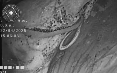 Phát hiện ký sinh trùng dài cuộn trong ruột bệnh nhân đầy bụng khó tiêu