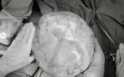 Phẫu thuật thành công khối u buồng trứng 4,3kg cho bệnh nhi 14 tuổi