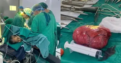 Phẫu thuật thành công khối u sau phúc mạc khổng lồ tại vị trí phức tạp