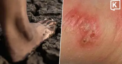 Thái Lan báo động đợt bùng phát bệnh Melioidosis với 732 ca nhiễm và 23 ca tử vong