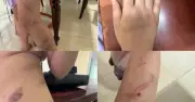 Bé gái 9 tuổi bị nghi bạo hành với 34 vết bầm tím, công an vào cuộc điều tra