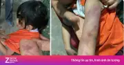 Bé gái lớp 2 ở Hà Tĩnh bị bạn dùng thước đánh bầm tím người trong giờ ra chơi
