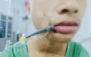 Bé Trai 15 Tuổi Ở Nghệ An Bị Lưỡi Câu Cá Móc Sâu Vào Mặt, May Mắn Được Cấp Cứu Kịp Thời