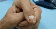 Bác sĩ Mỹ cảnh báo: Những dấu hiệu lạ ở móng tay có thể là tín hiệu bệnh thận
