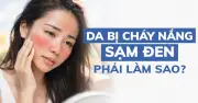 Bỏng Nắng Không Chỉ Là Đỏ Da: Cảnh Báo Nguy Cơ Và Bí Quyết Phục Hồi Thần Tốc