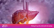 Bệnh gan nhiễm mỡ MASLD: 'Kẻ giết người thầm lặng' không do rượu đe dọa hàng tỷ người
