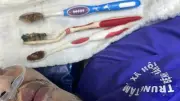 Bệnh nhân rối loạn tâm thần nuốt 3 bàn chải đánh răng được cứu sống nhờ can thiệp nội soi