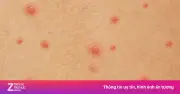 Cảnh báo: 'Bẫy' lây nhiễm thủy đậu khiến nhiều người chủ quan, tiềm ẩn nguy cơ lâu dài