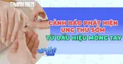 Cảnh báo: Dấu hiệu trên móng tay có thể cảnh báo sớm ung thư hiếm gặp