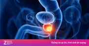 Cảnh báo ung thư di truyền: Gia đình 4 người mắc ung thư tuyến tiền liệt, con trai chủ quan qua đời