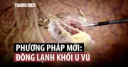 Đông lạnh khối u vú: Phương pháp mới thay thế phẫu thuật cho ung thư nguy cơ thấp