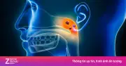 Người đàn ông tự điều trị viêm mũi, hóa ra mắc ung thư vòm họng