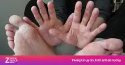 Tay chân miệng vào cao điểm: EV71 gây bệnh nặng, khi nào cần nhập viện?