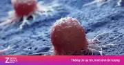 Ung thư khoang miệng: 'Sát thủ' ngụy trang tinh vi, ngày càng tấn công người trẻ