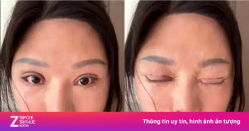 6 năm không nhắm kín mắt vì cắt mí hỏng tại phòng khám không phép