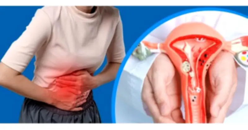 7 dấu hiệu thường gặp của lạc nội mạc tử cung chị em nên chú ý