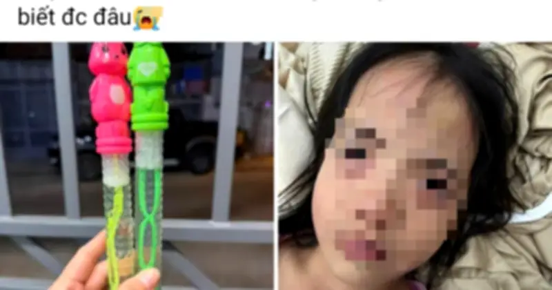 Bé 5 tuổi suýt mất thị lực vì đồ chơi thổi bong bóng chứa hóa chất độc hại