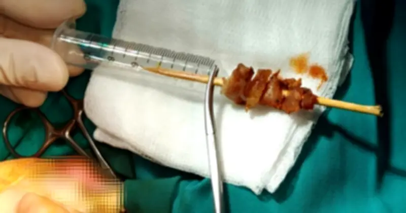 Bé gái 2 tuổi bị que xiên thịt đâm sâu vào hốc mắt, suýt mù vĩnh viễn