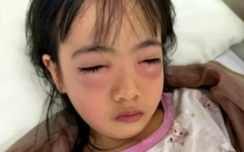 Bé gái 5 tuổi bị viêm kết mạc do dung dịch bong bóng xà phòng dính vào mắt