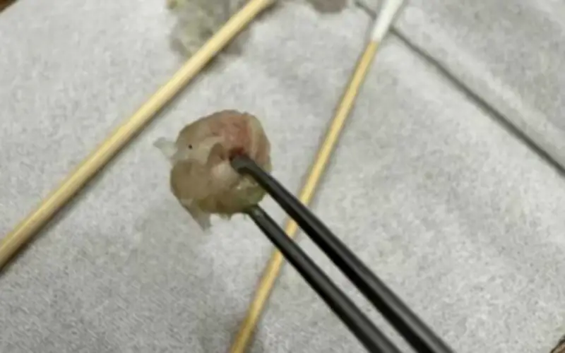 Bé gái 6 tuổi chảy máu mũi kéo dài, bác sĩ gắp ra cục giấy vệ sinh nén chặt