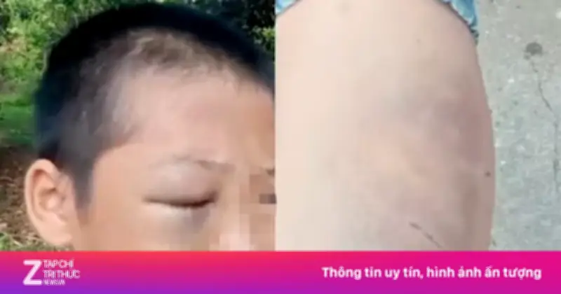 Bé trai 11 tuổi nghi bị bố và mẹ kế bạo hành ở Nghệ An, công an vào cuộc