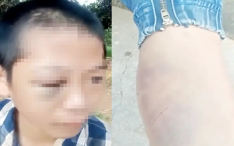 Bé trai 12 tuổi bị bố và mẹ kế đánh đập, công an vào cuộc