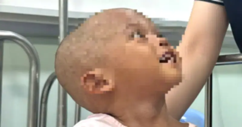 Bé trai 2 tuổi bị bạo hành dã man đã qua cơn nguy kịch