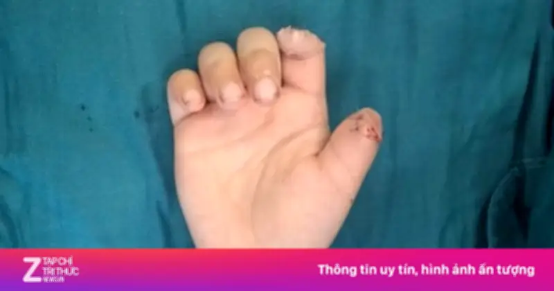 Bé trai 5 tuổi đứt lìa hai ngón tay khi chơi xe điện tự chế