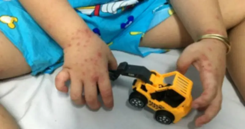 Bộ Y tế cảnh báo sốt xuất huyết và tay chân miệng gia tăng trong tháng 4