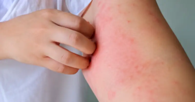Bệnh giun đũa chó mèo: Nguy cơ tiềm ẩn từ môi trường sống