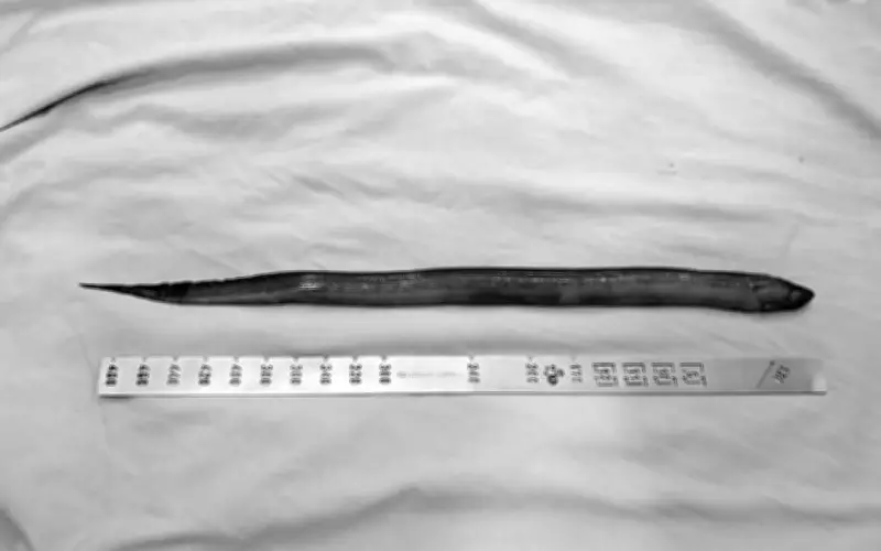 Bệnh viện Thống Nhất mổ lấy lươn dài 50cm trong ổ bụng nam bệnh nhân