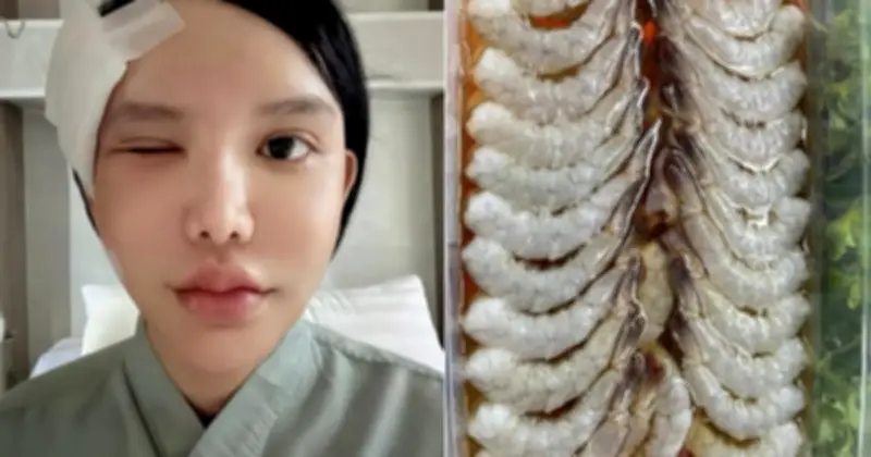 Cảnh báo: Ăn tôm sống ướp nước mắm có thể nhiễm ký sinh trùng nguy hiểm