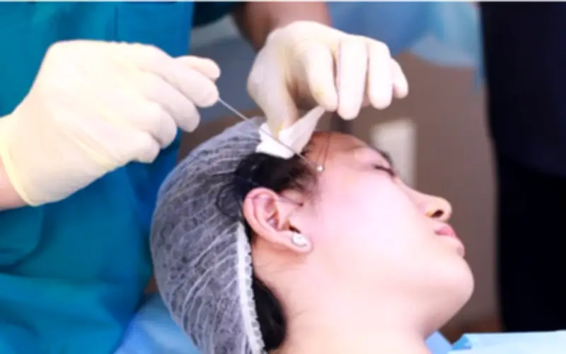 Cảnh báo trào lưu tự nâng cơ bằng chỉ tại nhà trên TikTok
