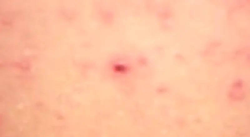 Cảnh báo virus Hanta trên tàu du lịch, Bộ Y tế khuyến cáo phòng bệnh