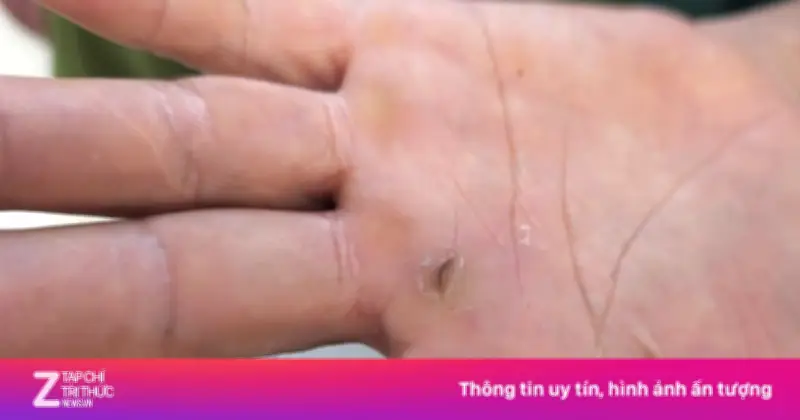 Dồn dập 3 ca tiêm phòng dại nhập viện trong 30 phút giữa nắng nóng