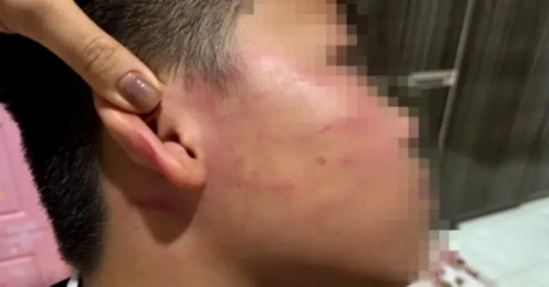 Học sinh lớp 4 bị giáo viên dạy thêm đánh bầm tím mặt ở Gia Lai