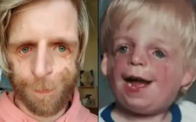 Jono Lancaster: Từ đứa trẻ bị bỏ rơi vì ngoại hình thành diễn giả truyền cảm hứng