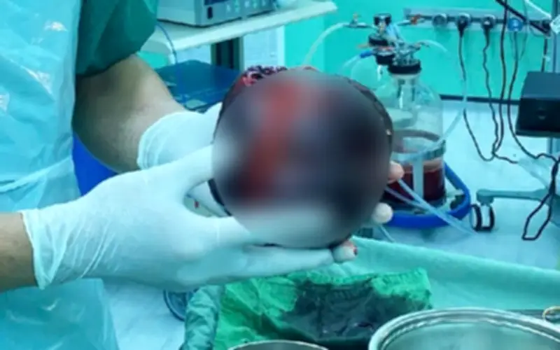 Khối u bụng vỡ suýt cướp mạng người đàn ông ở Tp.HCM