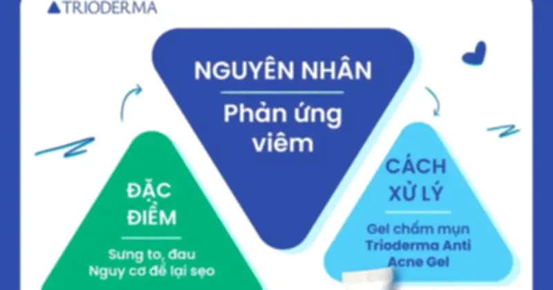 Mụn nổi trên trán: Nguyên nhân và kem chấm mụn Trioderma Anti Acne Gel hiệu quả