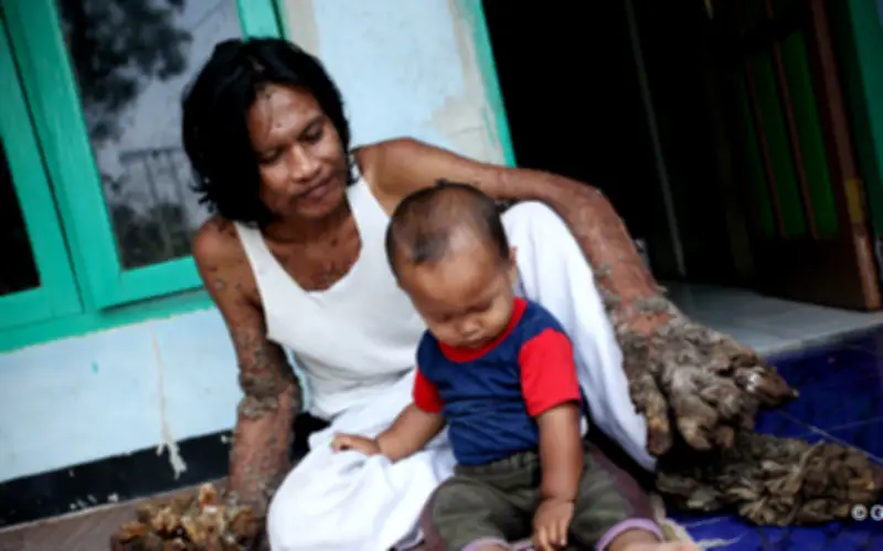 Người cây Indonesia: Từ vết xước đầu gối đến bi kịch cuộc đời