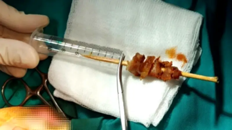 Que xiên thịt nướng đâm sâu vào mắt trẻ: Ca phẫu thuật hy hữu