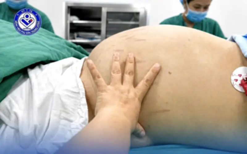 Thiếu nữ 19 tuổi mang khối u buồng trứng 30cm vì tâm lý chủ quan