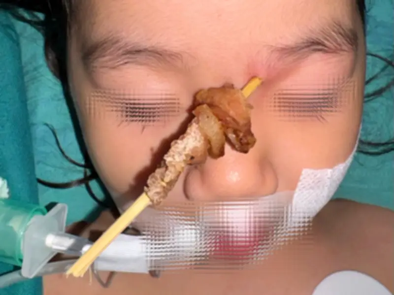 Vụ án rúng động: Bé gái 25 tháng tuổi bị que xiên thịt đâm ngược lên họng và nền sọ