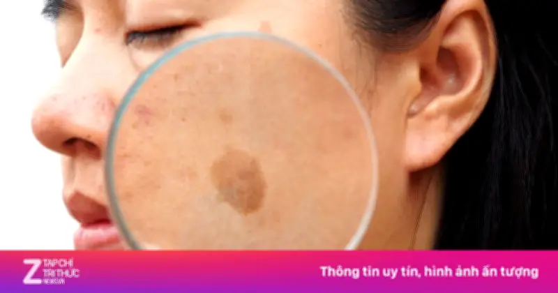 Vì sao phụ nữ dễ bị nám da khi mang thai? Nguyên nhân và giải pháp