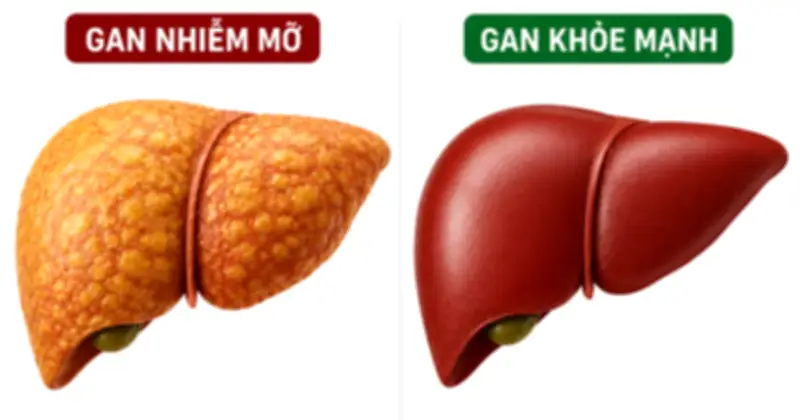 Vitamin B3 giúp giảm gan nhiễm mỡ nhờ ức chế miR-93