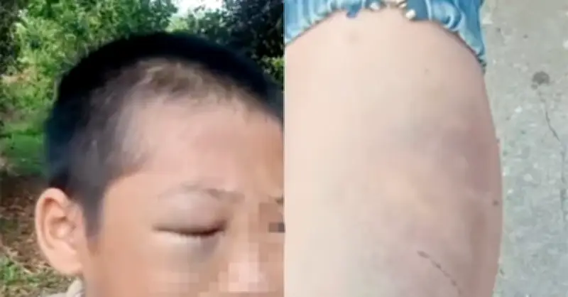 Xác minh clip bé trai mặt bầm tím nghi nhiều lần bị bạo hành