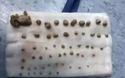 Bé trai 9 tuổi có 56 viên sỏi thận vì thói quen uống nước ngọt thay nước lọc