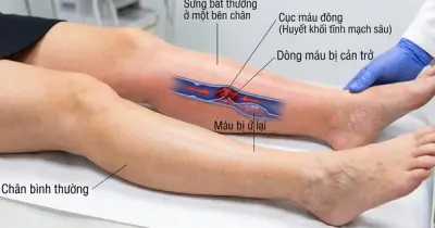 Dấu hiệu nhận biết sớm huyết khối tĩnh mạch sâu ở chân