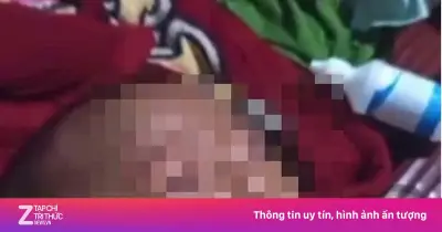 Vụ em bé bị cha ngược đãi ở Cần Thơ: Công an đã tiếp nhận vụ việc